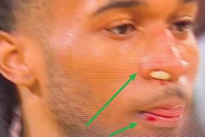 少林功夫卡斯尔嘴唇鼻子被打出血 “凶手”竟是文班……